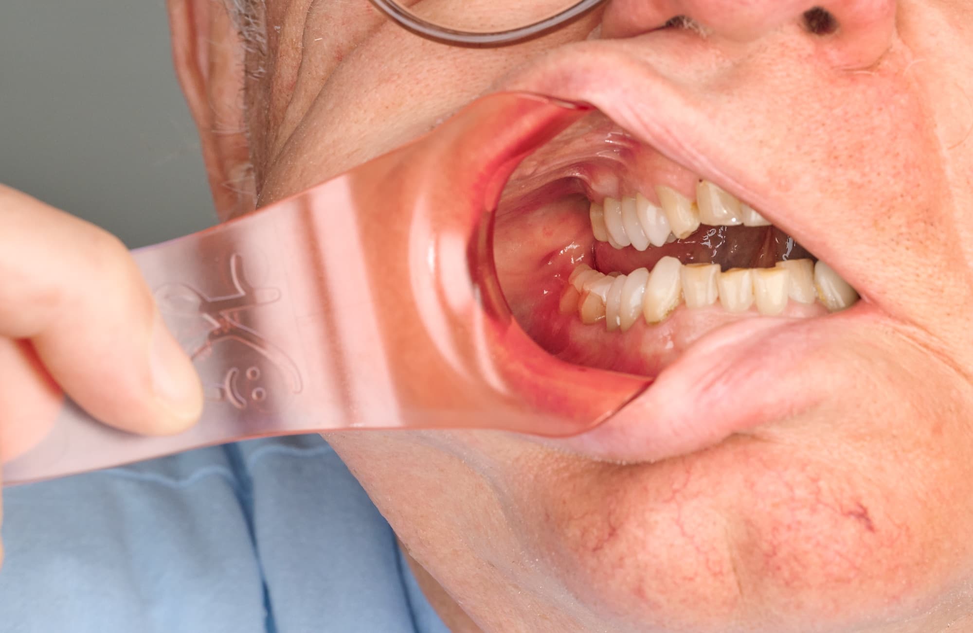 Der Lippen- und Wangenhalter hält die Wange seitlich ab, obere und untere Zahnreihe liegen auf ganzer Länge frei