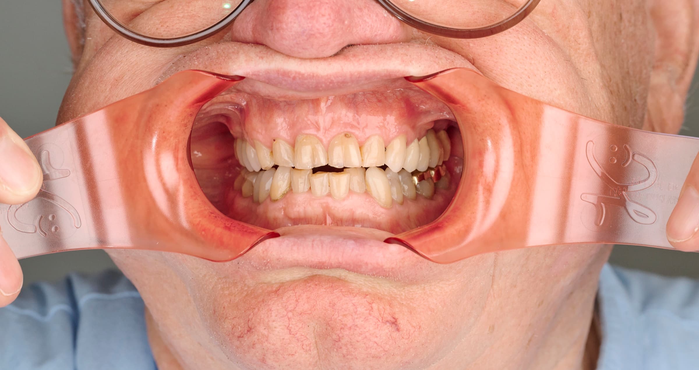Frontale Aufnahme: Der Lippen- und Wangenhalter hält Lippen und Wangen beidseitig zurück, die obere und untere Zahnreihe liegen vollständig frei. Zwei Hände halten den Halter an seinen Griffen.