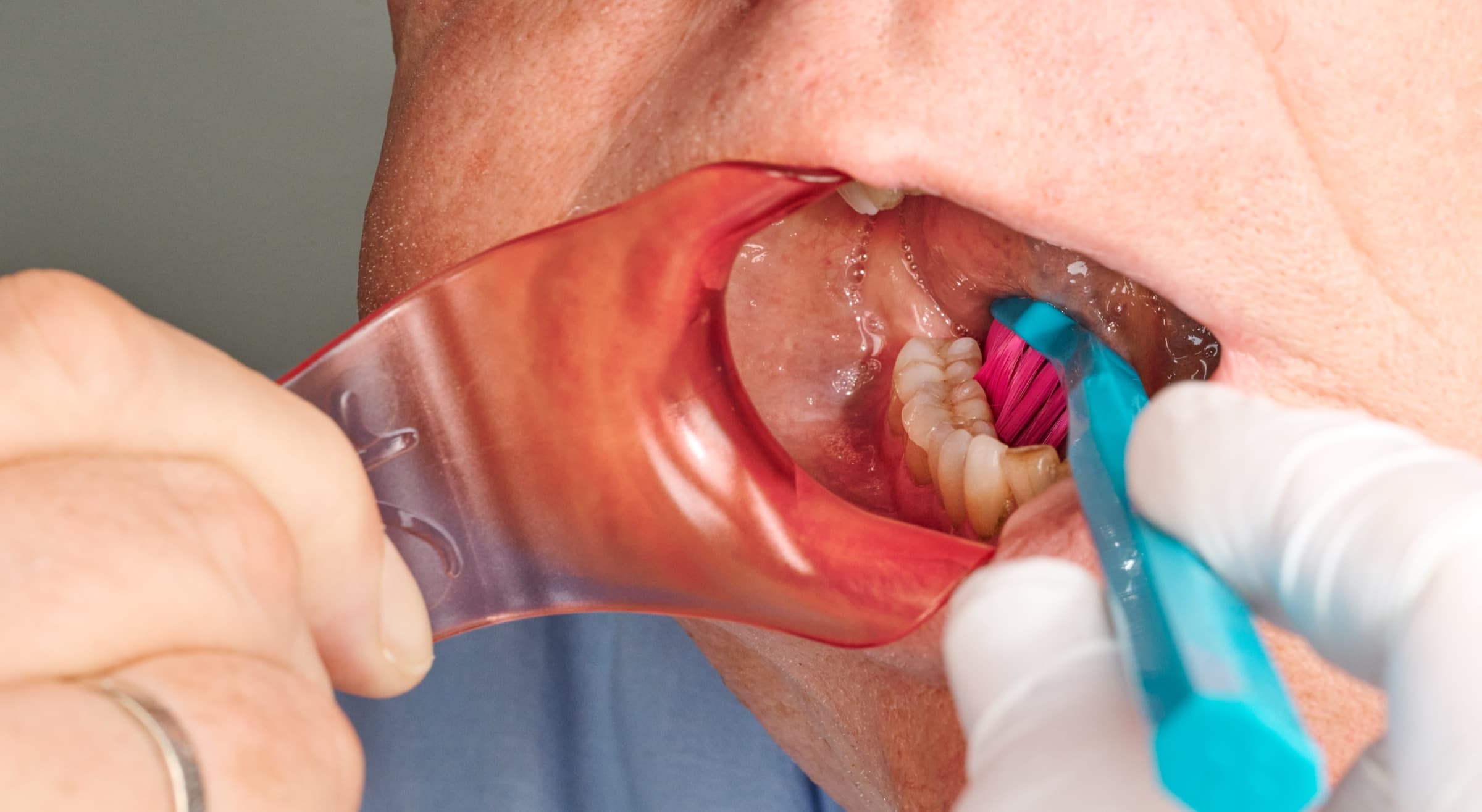 Nahaufnahme eines geöffneten Mundes: Der Lippen- und Wangenhalter hält Lippen und Wangen zurück, eine Zahnbürste reinigt den freiliegenden Seitenzahnbereich