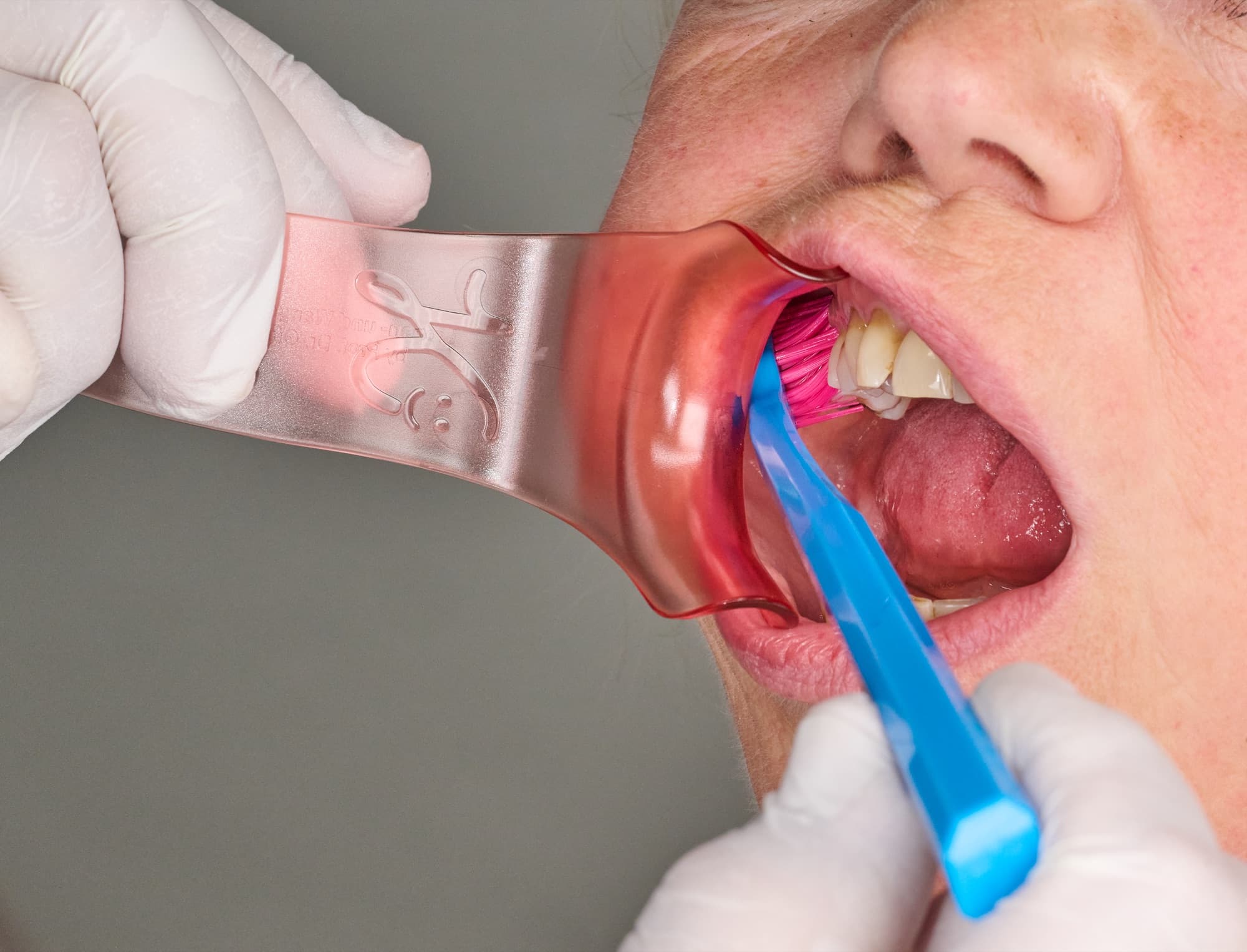 Mundpflege mit Handschuhen und eingesetztem Lippen- und Wangenhalter, die Bürste erreicht den Zahnfleischrand