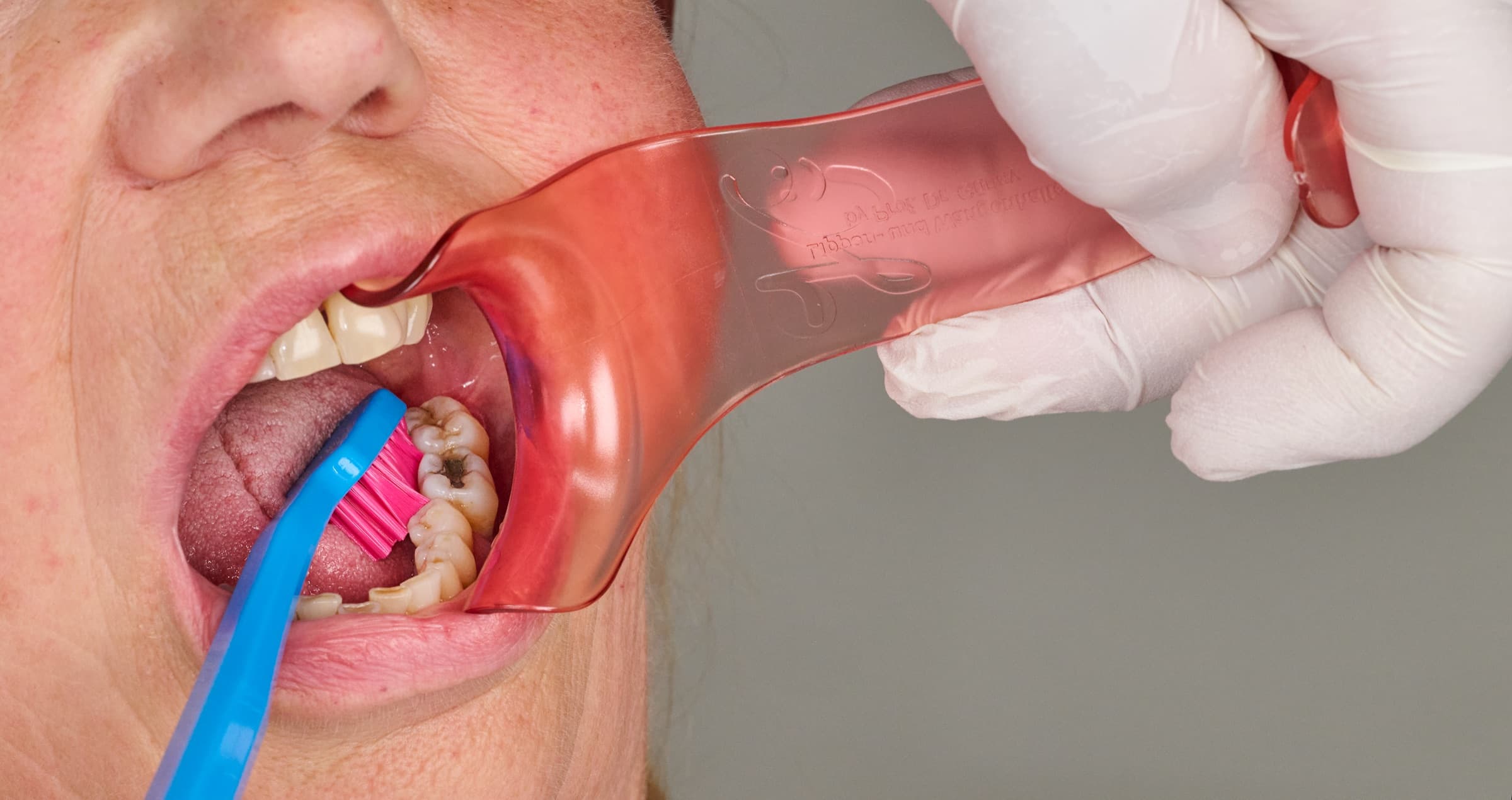 Weite Aufnahme: Der Lippen- und Wangenhalter gibt die gesamte Zahnreihe frei, während eine Zahnbürste die Seitenzähne reinigt