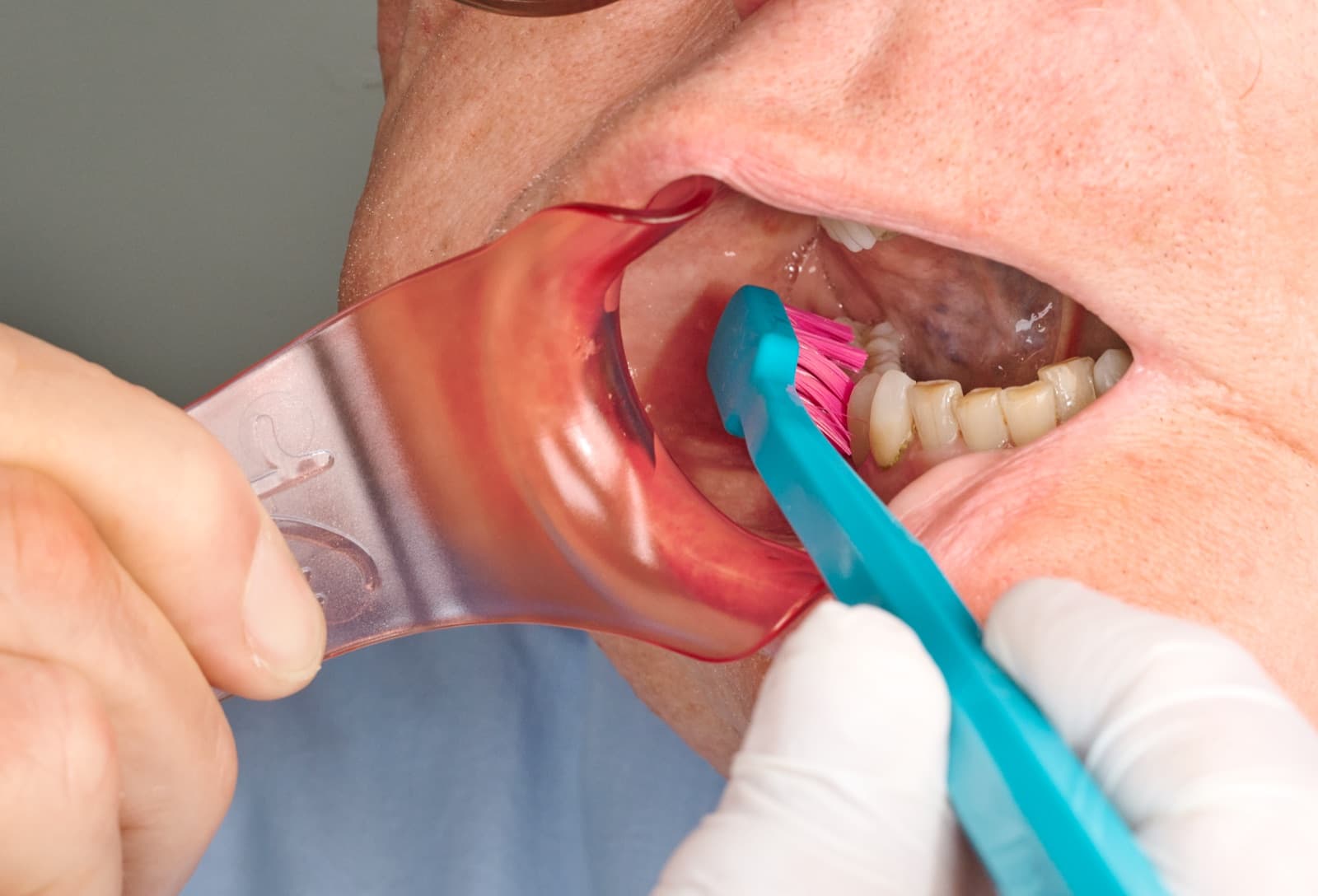Zähneputzen mit dem Lippen- und Wangenhalter: Lippen und Wangen sind dreidimensional abgehalten, die Zahnreihe liegt frei